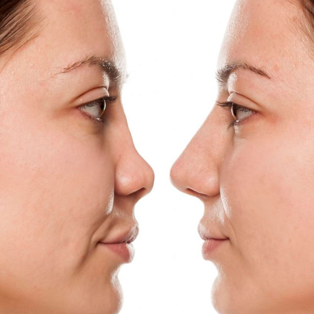 rinoplastia en Guadalajara